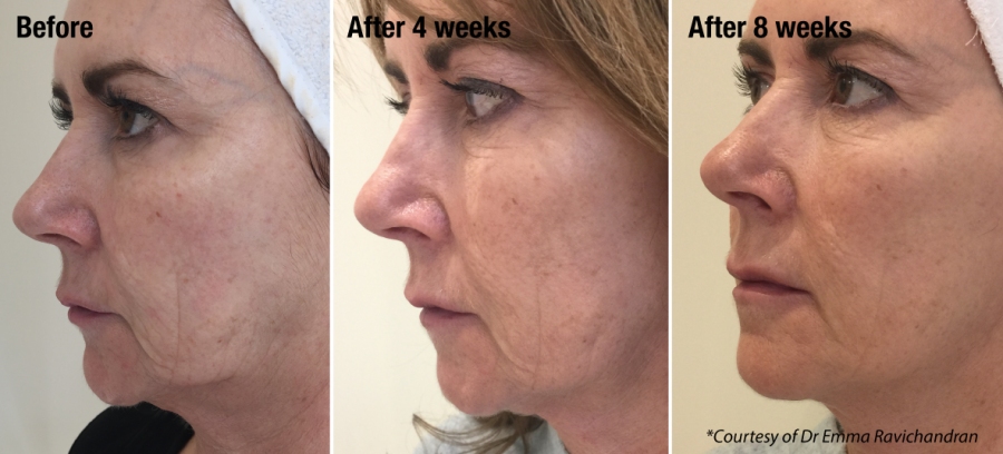 non surgical facelift Portsmouth