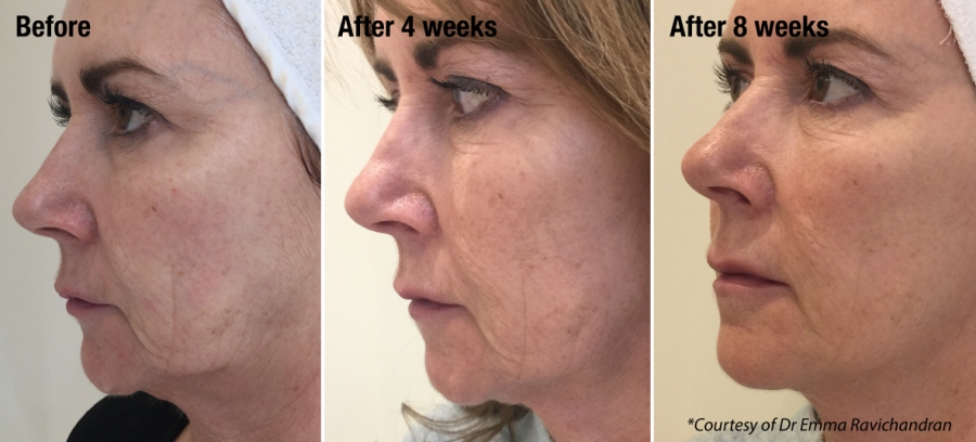 non surgical facelift Portsmouth Southampton