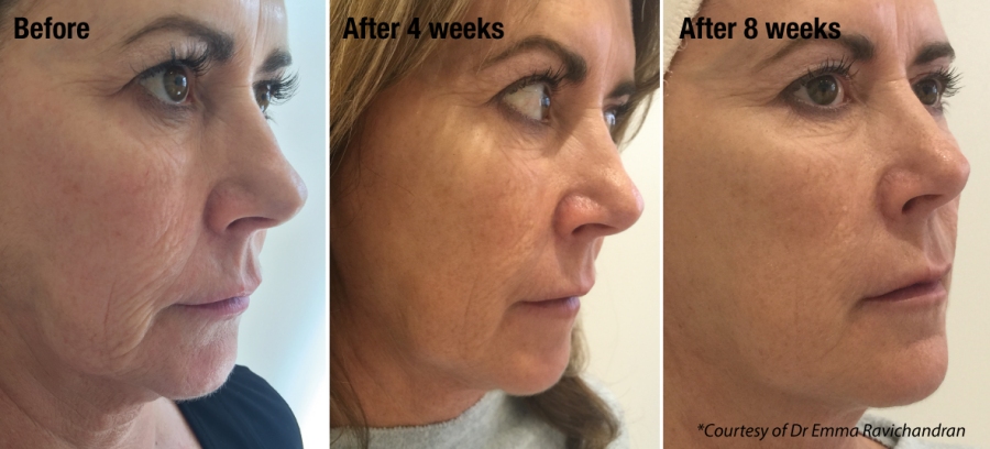 non surgical facelift Portsmouth