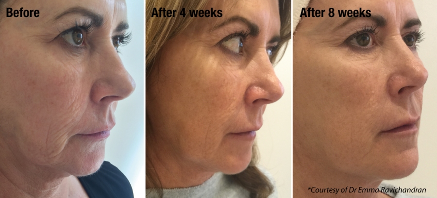 non surgical facelift Portsmouth Southampton