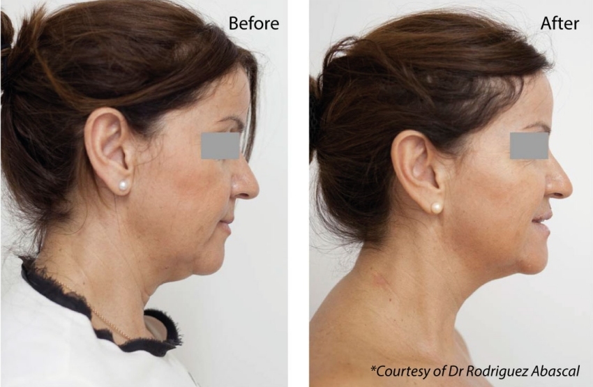 non surgical facelift Portsmouth Southampton